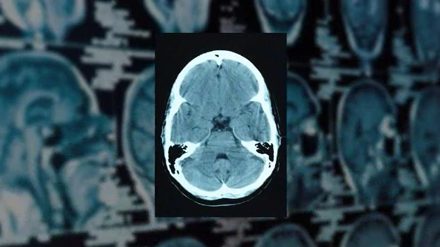 anosognosia-lobe