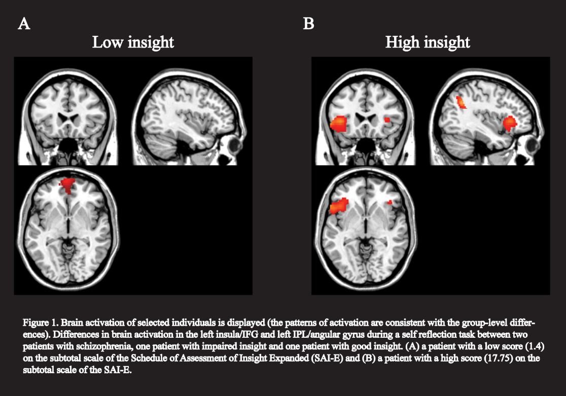 anosognosia1