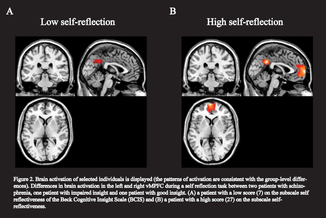 anosognosia2